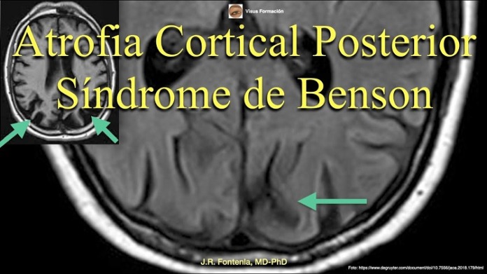 atrofia cortical
