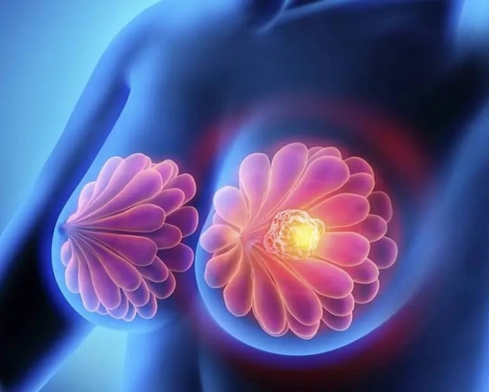Cáncer de mama